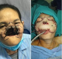 Làm lại mặt cho nữ bệnh nhân bị ung thư "ăn" mất mũi, môi