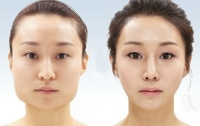 25 bức ảnh trước và sau phẫu thuật gây sốc ở Hàn Quốc