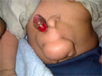 <Astic> Bào thai dị dạng sống ký sinh trong cơ thể bé trai