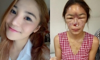 Sốc trước gương mặt "nát bét" của hot girl Thái Lan sau khi PTTM hỏng