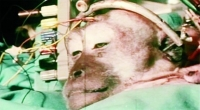 Thông tin mới nhất về ca phẫu thuật ghép đầu người đầu tiên trong lịch sử nhân loại