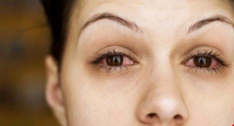 15 nguyên nhân khiến mắt bạn thường xuyên bị đỏ