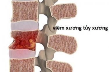 Tìm hiểu về bệnh viêm tủy xương
