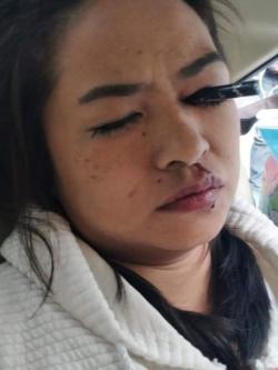Trang điểm trên taxi, cô gái bị bút đâm thủng mắt